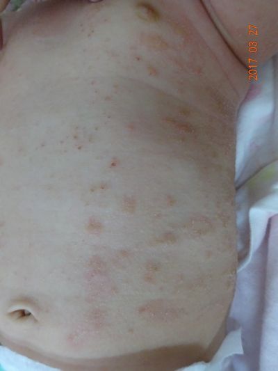 小児皮膚科治療前の写真