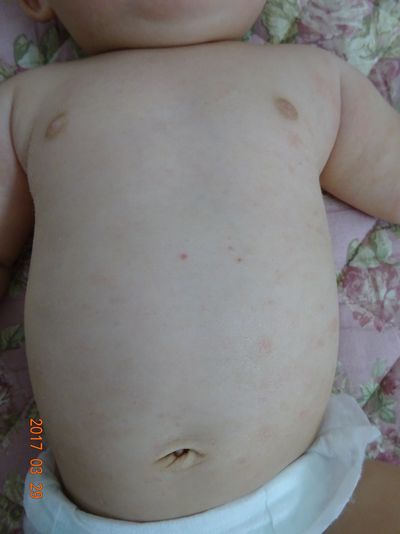 小児皮膚科治療2日後の写真